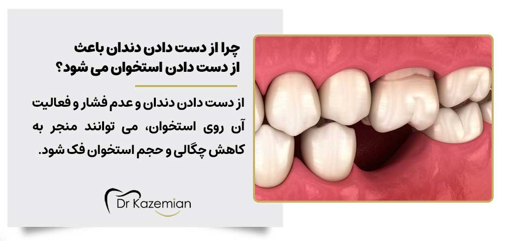 چرا از دست دادن دندان باعث از دست دادن استخوان می‌ شود؟