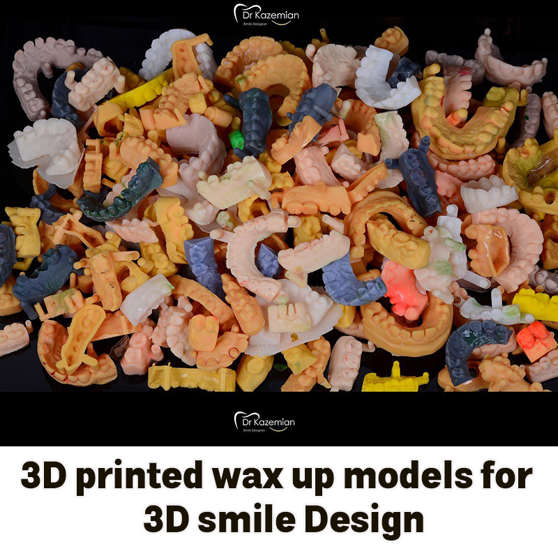 3D printed wax up models for 3Dsmile Design