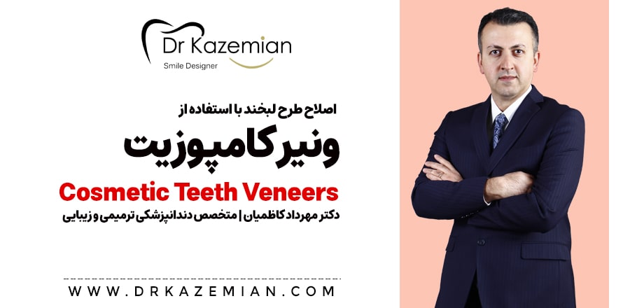 اصلاح طرح لبخند با ونیر کاموزیت در اصفهان | دکتر کاظمیان دندانپزشک زیبایی و ترمیمی