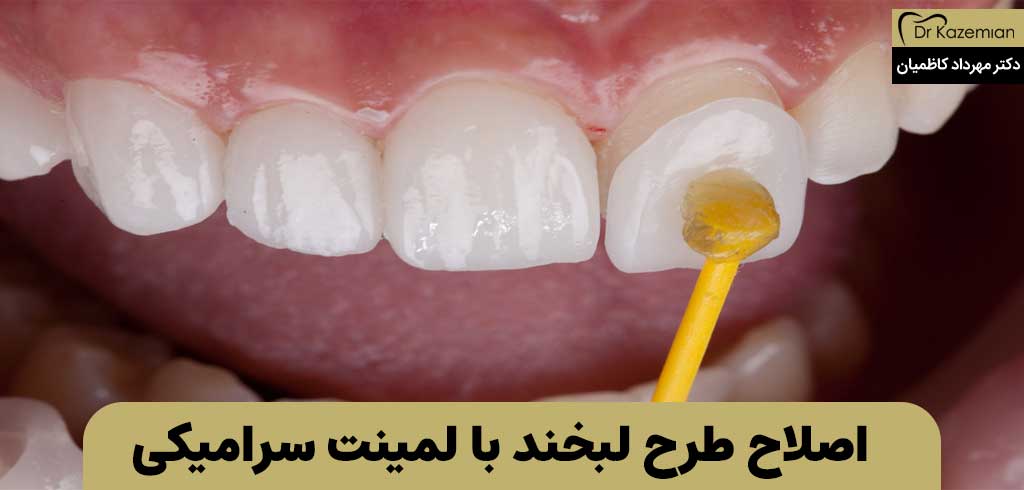  اصلاح طرح لبخند با لمینت سرامیکی | دکت مهرداد کاظمیان دندانپزشک زیبایی در اصفهان