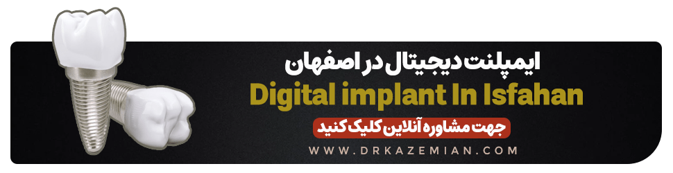 مشاوره و گرفتن نوبت از دکتر کاظمیان برای انجام ایمپلنت دیجیتال در اصفهان