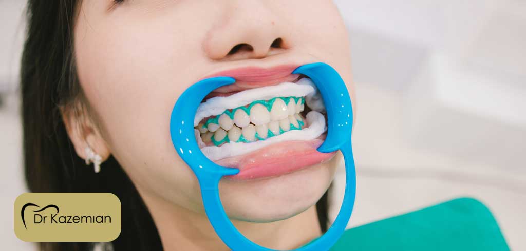 معایب سفید کردن دندان