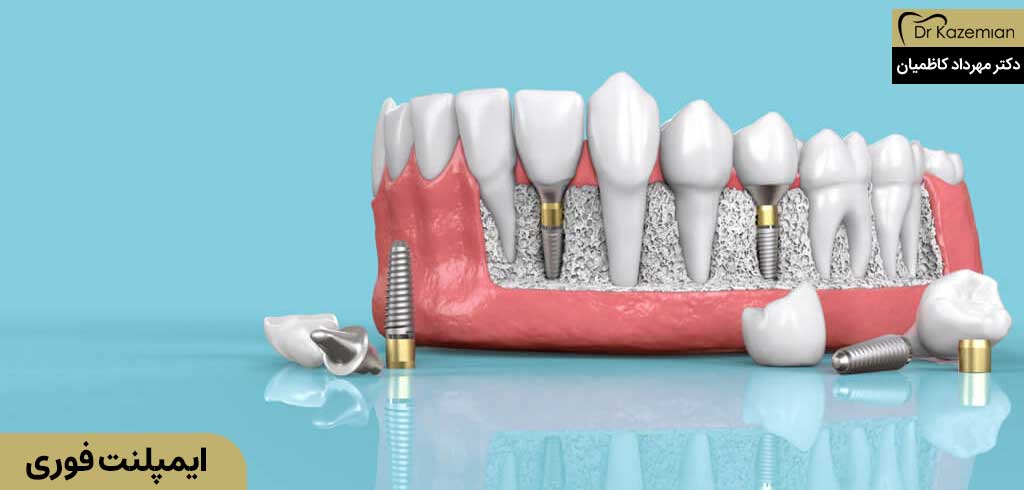 ایمپلنت فوری دندان در اصفهاان | دکتر کاظمیان