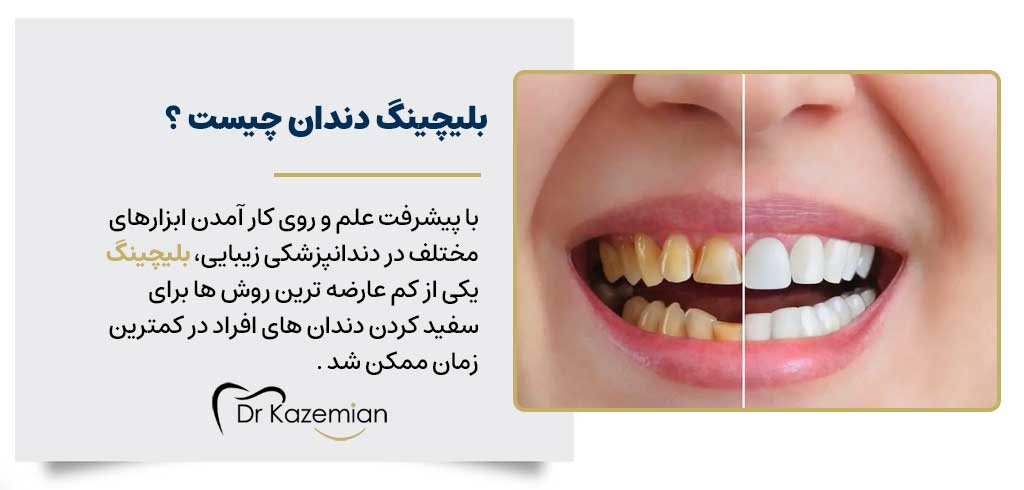 بلیچینگ دندان | دکتر کاظمیان دندانپزشک زیبایی در اصفهان
