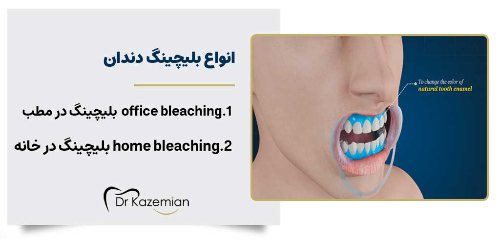 انواع انجام بلیچینگ دندان | دکتر کاظمیان دندانپزشک زیبایی رد اصفهان