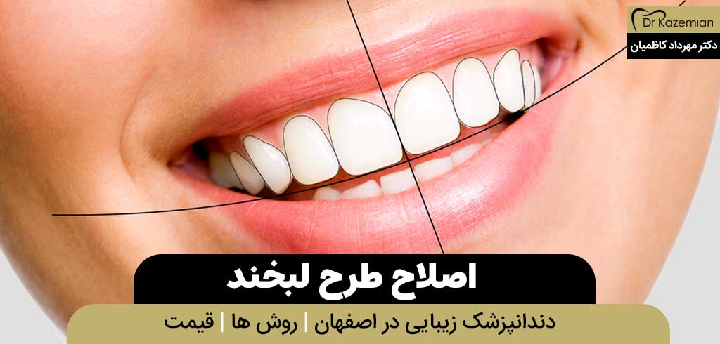 اصلاح طرح لبخند در اصفهان