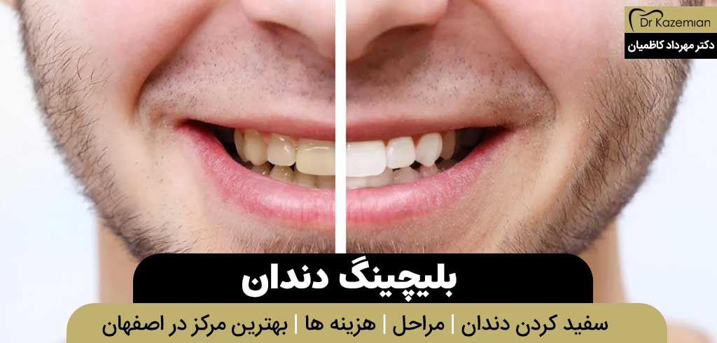 بلچینگ دندان (سفید کردن دندان) در اصفهان