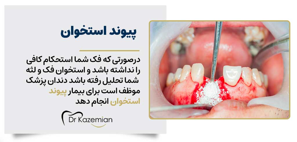 پیوند استخوان برای انجام ایمپلنت دندان | دکتر کاظمیان متخصص ایمپلنت اصفهان