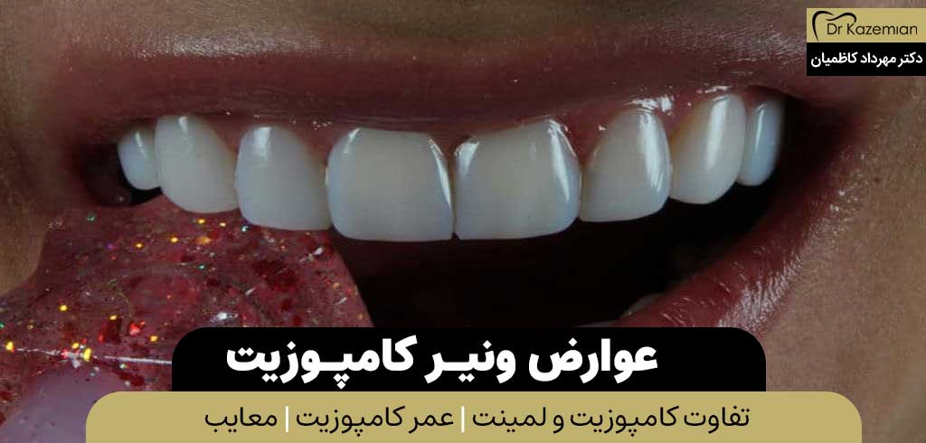 عوارض و معایب ونیر کامپوزیت دندان | دکتر کاظمیان دندانپزشک زیبایی در اصفهان