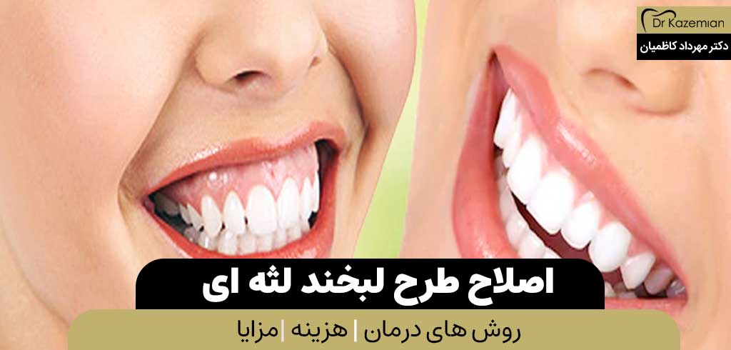 اصلاح طرح لبخند لثه ای | دکتر مهرداد کاظمیان دندانپزشک زیبایی در اصفهان