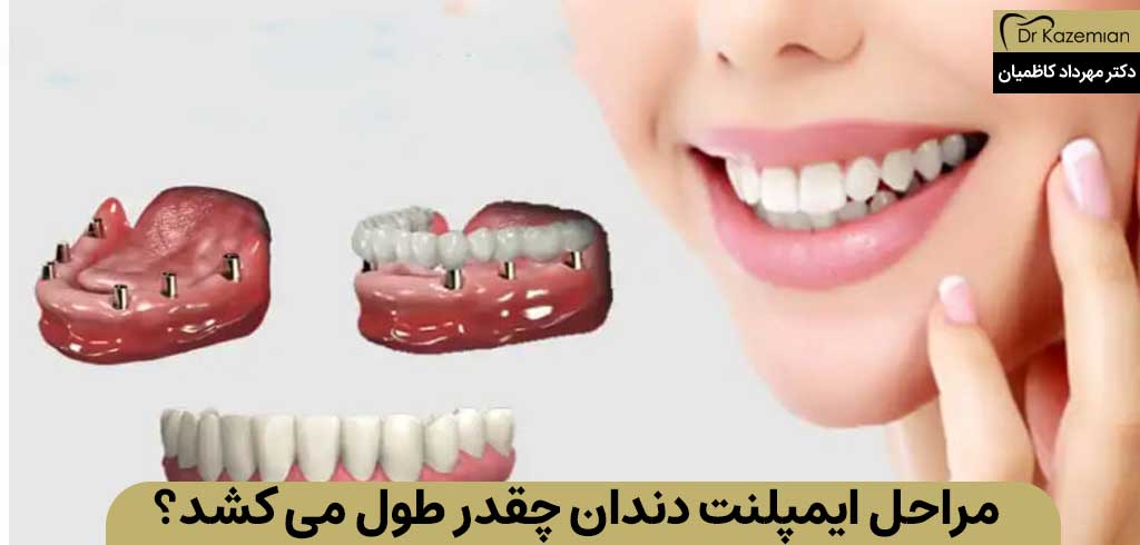 مراحل ایمپلنت دندان چقدر طول می کشد؟ | دکتر مهرداد کاظمیان