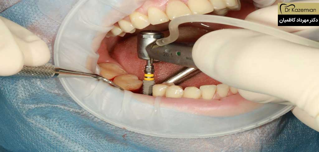ایمپلنت دندان در اصفهان | دکتر مهرداد کاظمیان دندانپزشک زیبایی در اصفهان