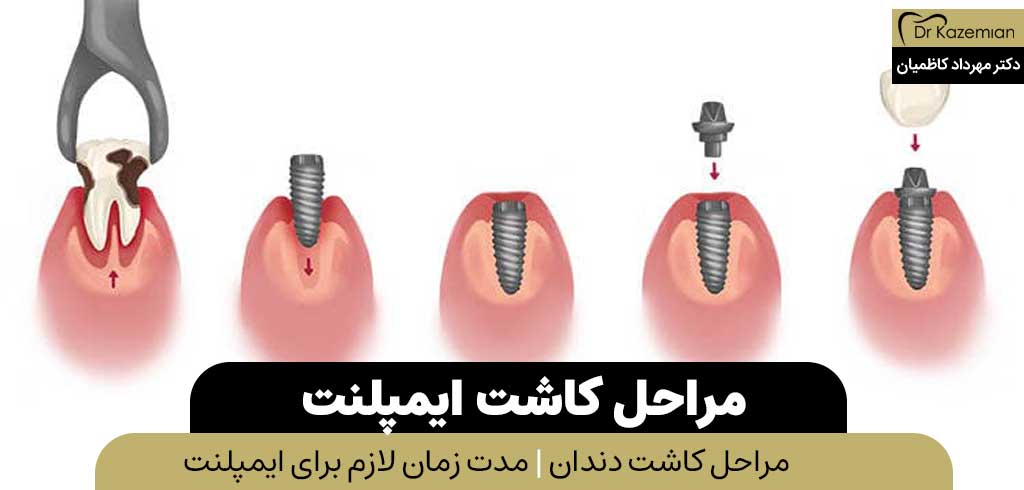 مراحل کاشت ایمپلنت | دکتر مهرداد کاظمیان متخصص دندانپزشک زیبایی در اصفهان