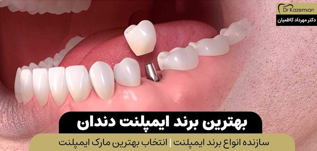 بهترین ایمپلنت دندان در اصفهان | دکتر کاظمیان دندانپزشک زیبایی در اصفهان