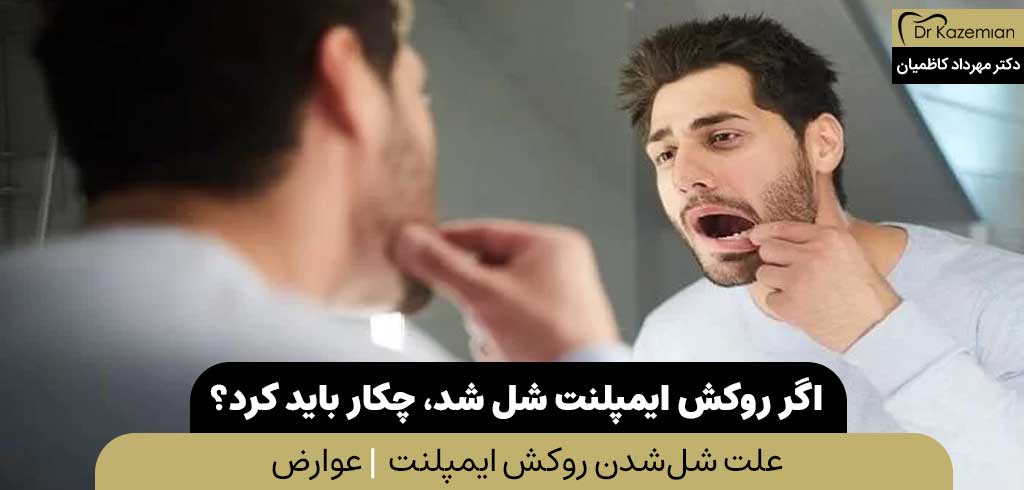 اگر روکش ایمپلنت شل شد، چکار باید کرد؟ | دکتر کاظمیان دندانپزشک زیبایی در اصفهان