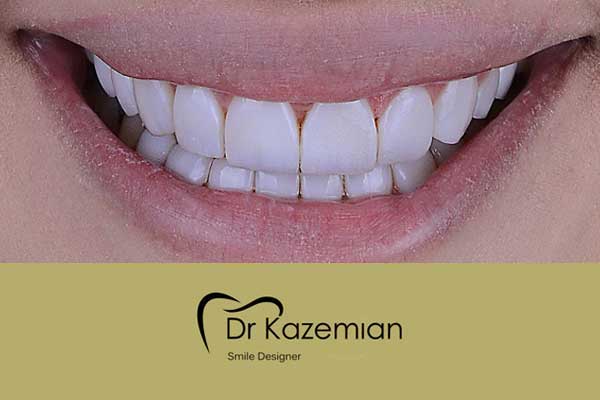 عکس دندان بعد از دندانپزشکی زیبایی توسط دکتر کاظمیان اصفهان