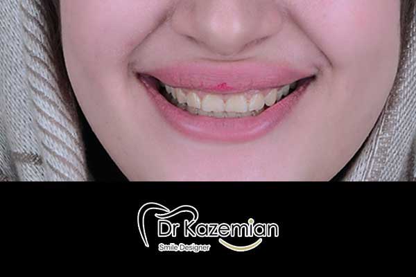 عکس قبل از دندانپزشکی زیبایی - قبل لمینت