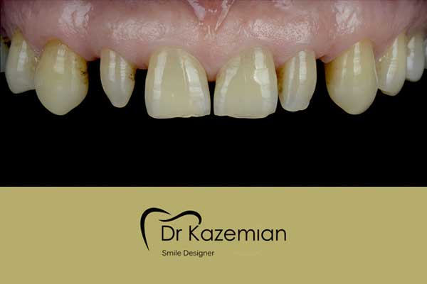 عکس دندان قبل از دندانپزشکی زیبایی توسط دکتر کاظمیان اصفهان