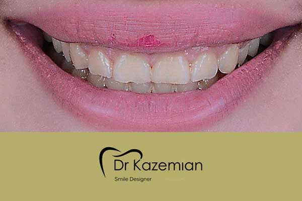 عکس دندان قبل از دندانپزشکی زیبایی توسط دکتر کاظمیان اصفهان
