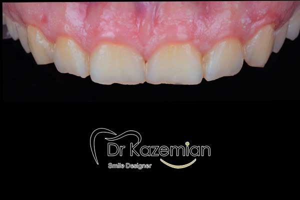 عکس دندان های فک بالا قبل از دندانپزشکی زیبایی توسط دکتر کاظمیان