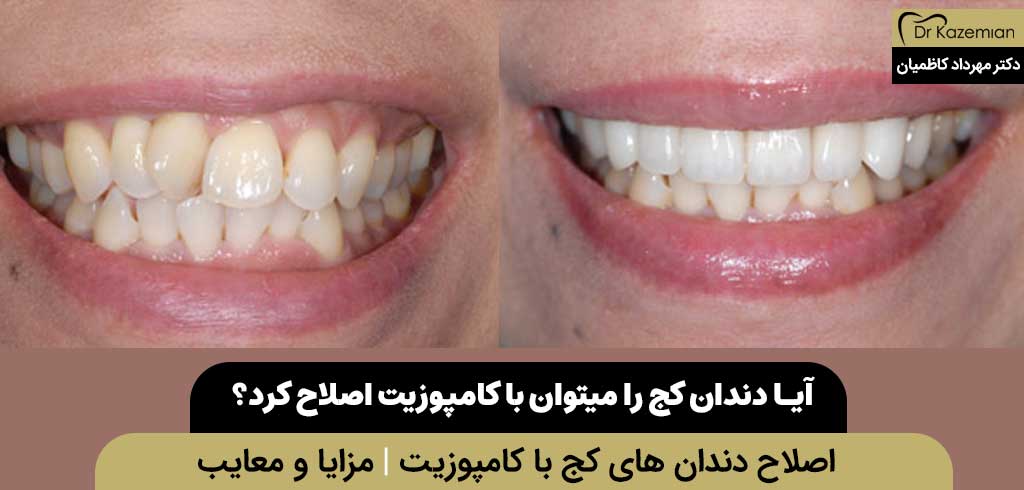 آیا دندان کج را میتوان با کامپوزیت اصلاح کرد؟