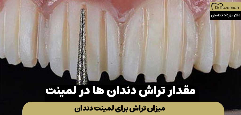 میزان تراش دندان‌ها برای لمینت