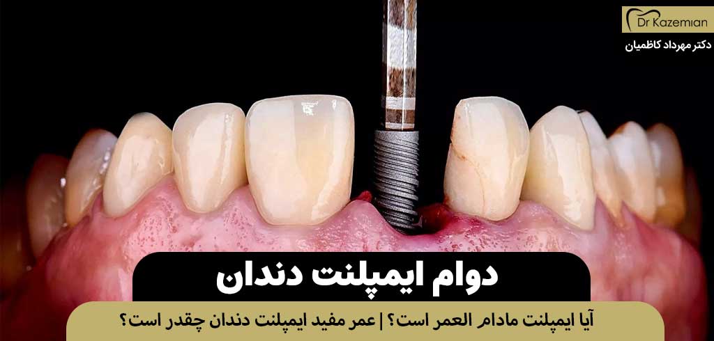 دوام ایمپلنت دندان | آیا ایمپلنت مادام العمر است؟