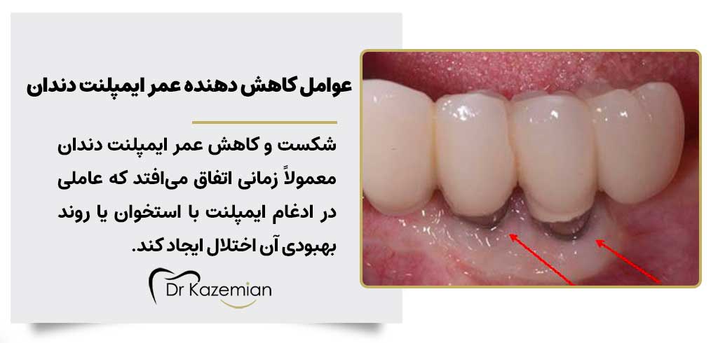 عوامل کاهش دهنده عمر ایمپلنت دندان