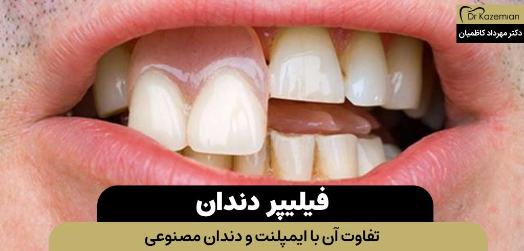 فیلیپر دندان | تفاوت آن با ایمپلنت و دندان مصنوعی