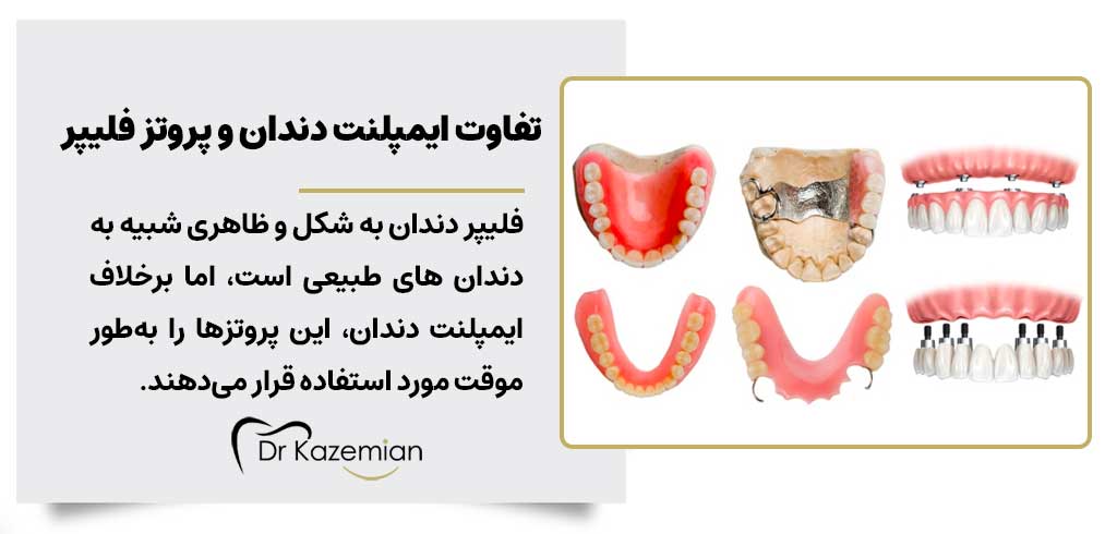 ایمپلنت دندان و پروتز فلیپر چه تفاوت هایی با یکدیگر دارند؟