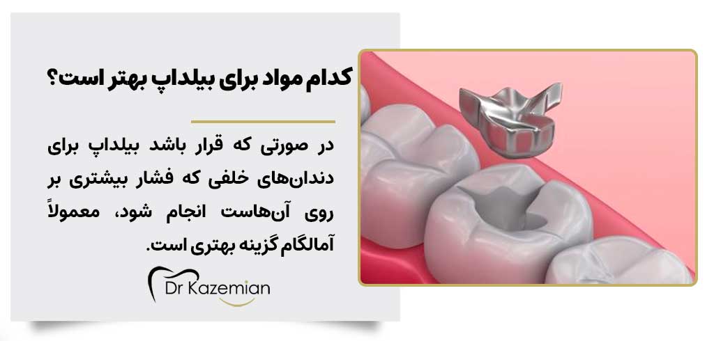 کدام مواد برای بیلداپ دندان بهتر است؟