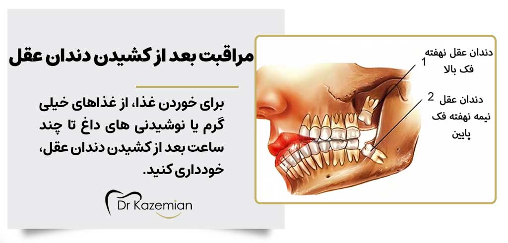 مراقبت بعد از کشیدن دندان عقل