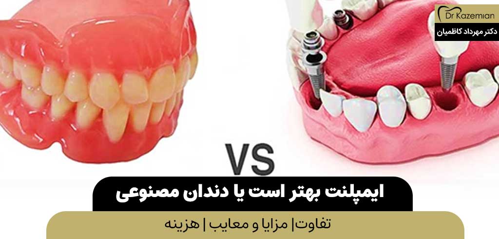 ایمپلنت بهتره یا دندان مصنوعی