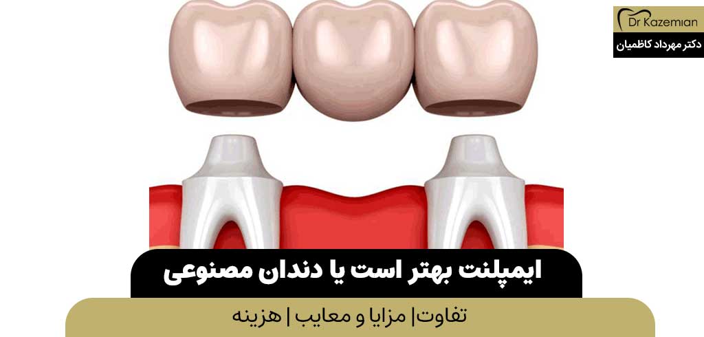 بریج یا پل دندان چیست؟ کاربرد + دوام + هزینه