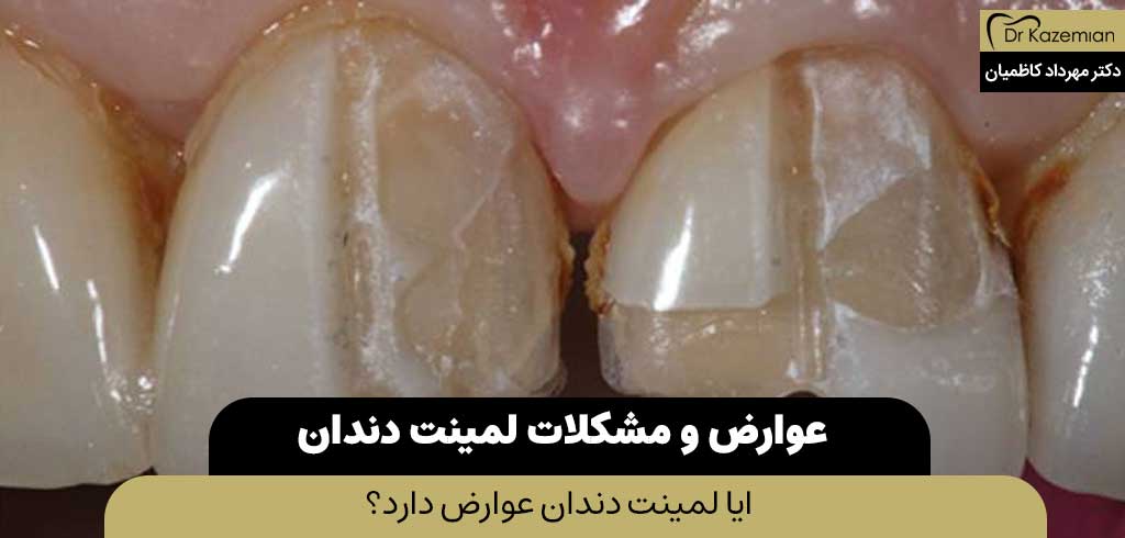 عوارض و مشكلات لمينت دندان | پشیمانی از لمینت