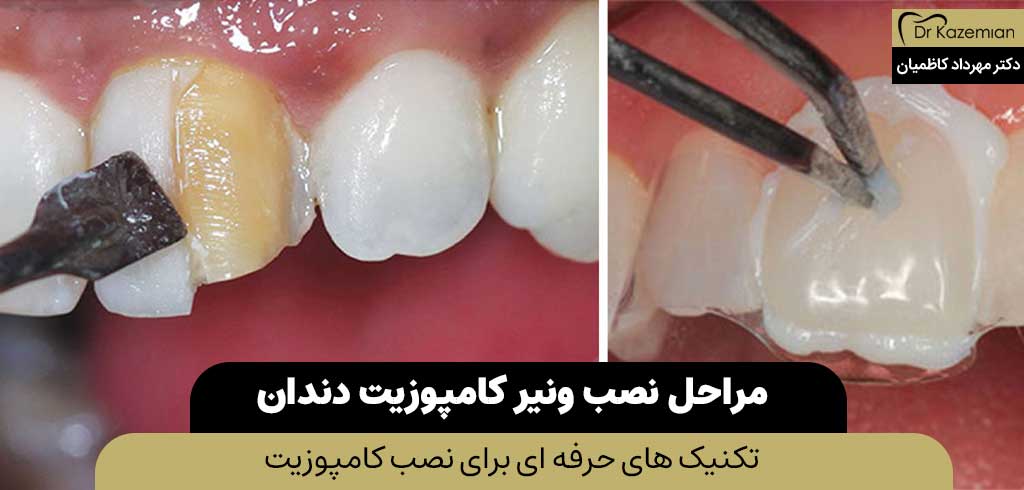 مراحل نصب ونیر کامپوزیت دندان(تکنیکهای حرفه ‌ای برای نصب)